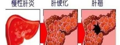 肝癌肝内扩散吃印度多吉美的简单介绍(印度多吉美治疗肝癌效果好么 )