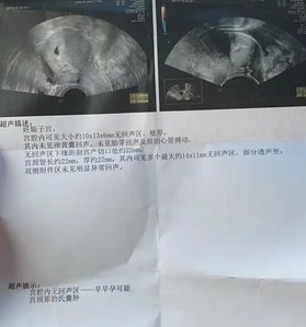 如何确诊宫外怀孕？早期发现，避免危险！_现代网新闻频道