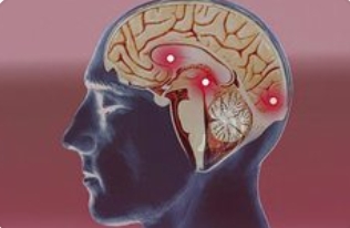 脑干出血:不容忽视的致命警报_现代网新闻频道